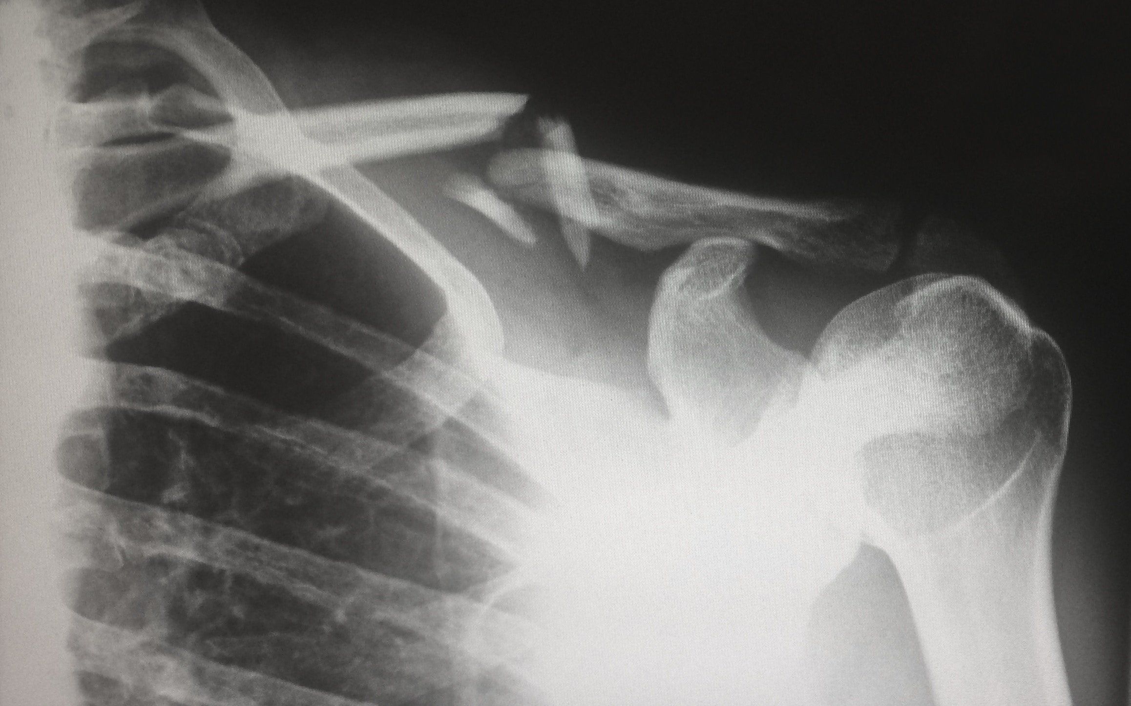 blog-bonehealth